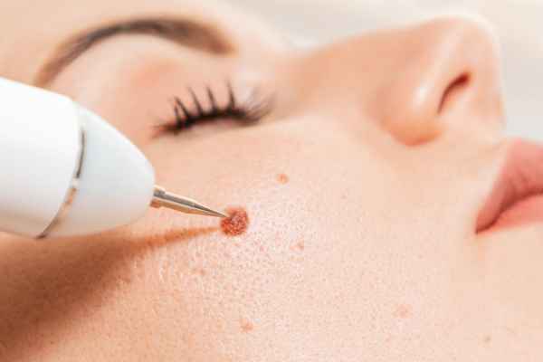 CryoPen: 5 Skin Concerns It May Be Used to Treat 3 What actually happens during a CryoPen treatment Herne?