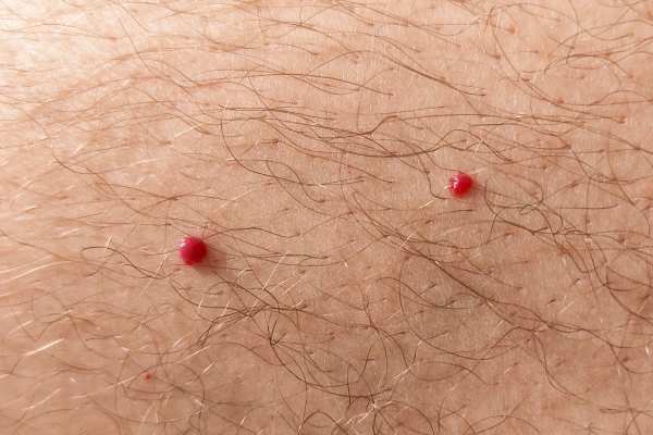 CryoPen: 5 Skin Concerns It May Be Used to Treat 2 cherry angioma removal Herne