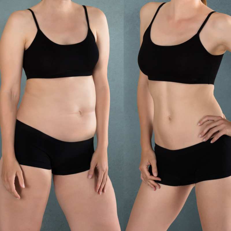 Does Fat Freezing at Home Work? DIY Devices vs Professional Cryolipolysis 2 before and after Cryolipolysis Herne