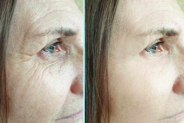 Why Do People Choose HIFU for a Non-Surgical Facelift? 4 How long can HIFU results last Herne?