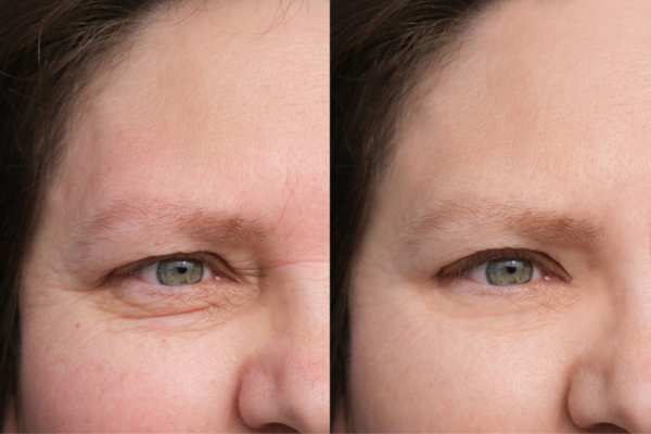 HIFU vs Botulinum Toxin: Understanding the Differences 4 How long do HIFU results last Herne?