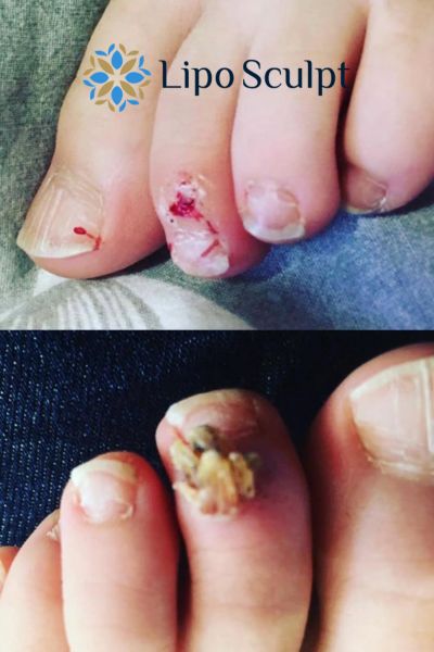 Wart removal customer results from Lipo Sculpt Herne